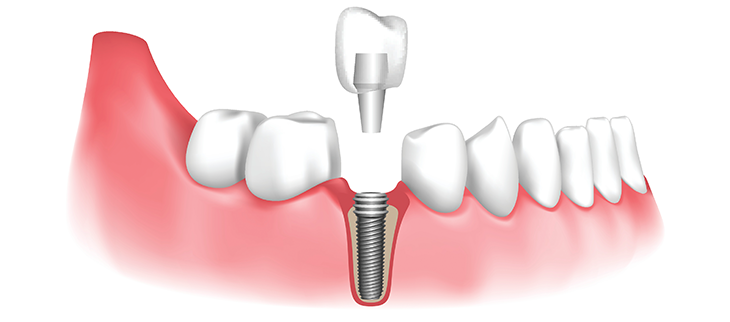 How To Get Dental Implants 2025